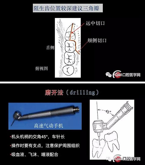 智齿拔除