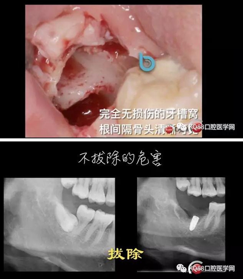 智齿拔除