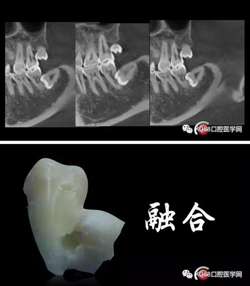 智齿拔除