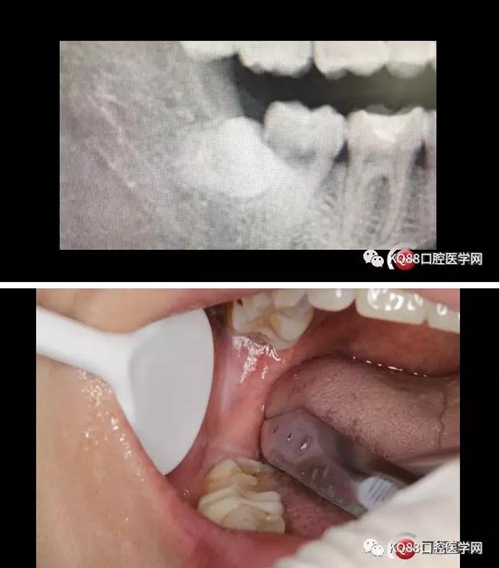 智齿拔除