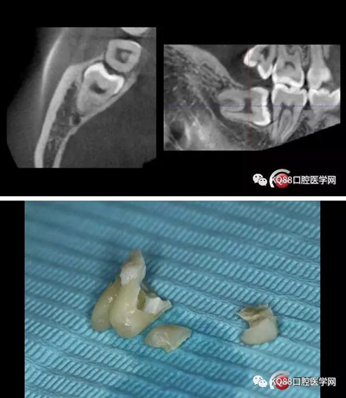 智齿拔除