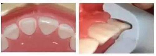 前牙全瓷冠牙体预备步骤   