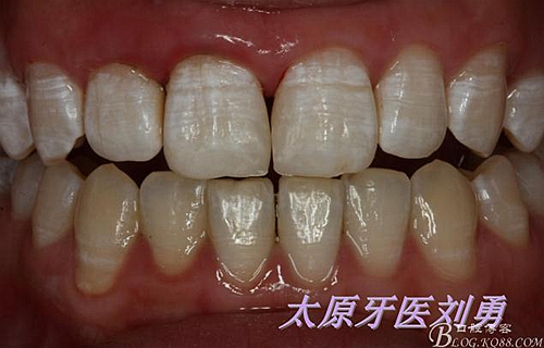刘勇：断牙再粘结两例病例 