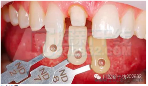 义获嘉 Ivoclar Vivadent 比色板 A-D16色 Ivoclar Shade Guide A-D16