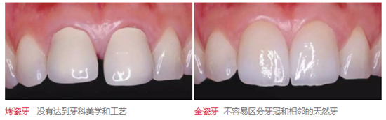 医生，我的烤瓷牙上有个黑线怎么回事？