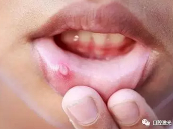 原创 |利用半导体激光治疗口腔溃疡