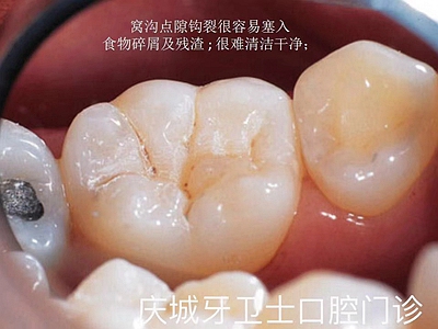爱牙科普-来自临床的窝沟封闭