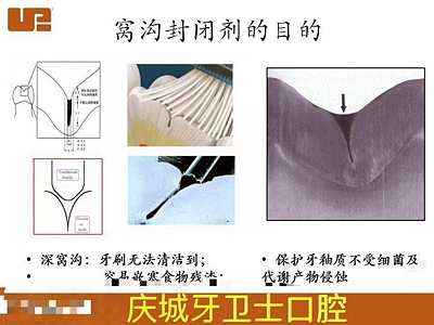 爱牙科普-来自临床的窝沟封闭