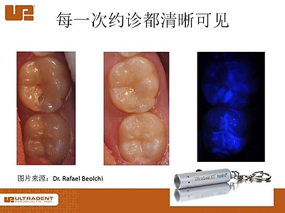 爱牙科普-来自临床的窝沟封闭
