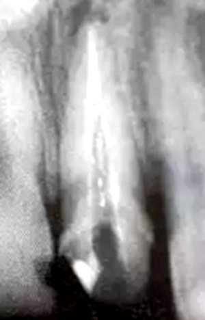 纤维桩修复之精细操作