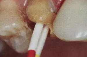 纤维桩修复之精细操作