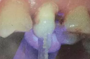 纤维桩修复之精细操作