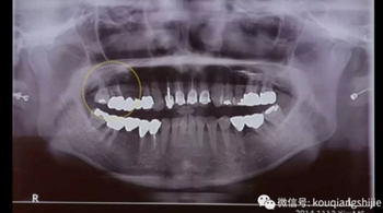 拔牙窝的处理-新思路