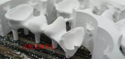 全锆牙冠裂原因分析—操作流程工艺以及患者日常使用