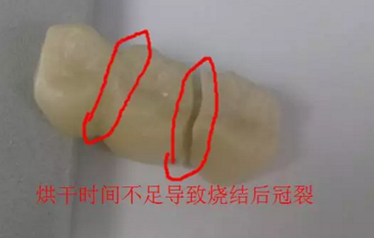 全锆牙冠裂原因分析—操作流程工艺以及患者日常使用