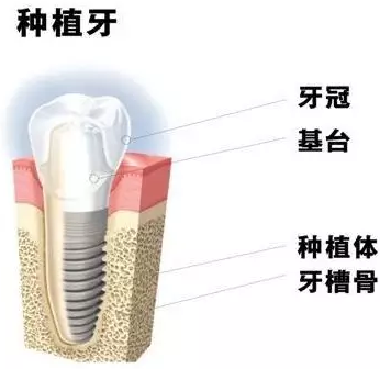 种植牙会松动的原因是什么？