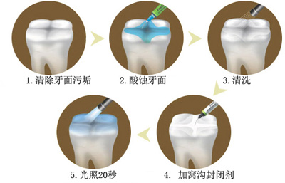 窝沟封闭丨孩子牙齿的“铠甲勇士”