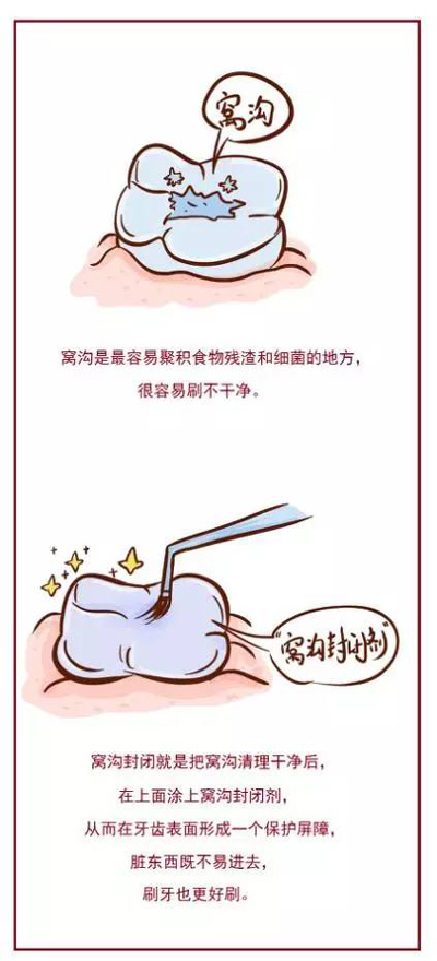 窝沟封闭丨孩子牙齿的“铠甲勇士”
