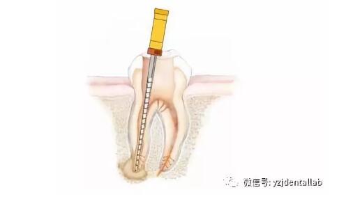 根管治疗
