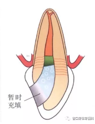 上前牙根管再治疗后内漂白1例