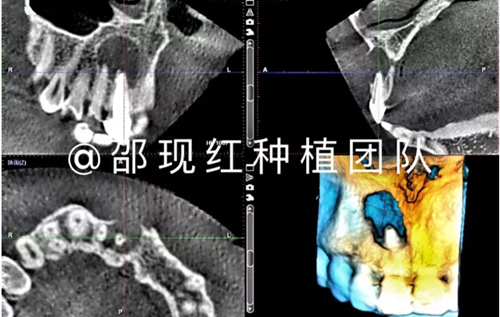 「科普篇」你真的了解它吗？——β-磷酸三钙