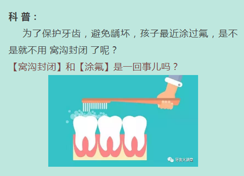 窝沟封闭剂