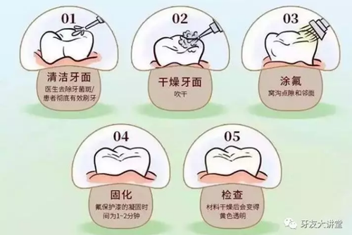 窝沟封闭剂