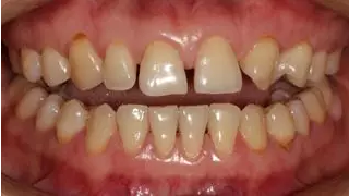 病例分享｜复合树脂微创美学修复关闭上前牙间隙