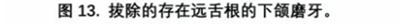 宇森SC-Pro镍钛根管锉|宇森医疗根管治疗器械领跑者