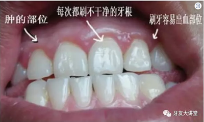 怎样预防牙龈萎缩