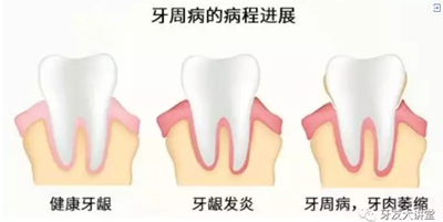 怎样预防牙龈萎缩