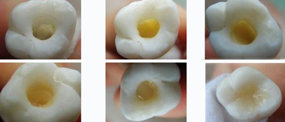 各类洞形的树脂充填方法
