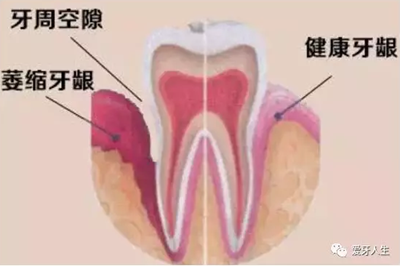 什么是牙龈萎缩？