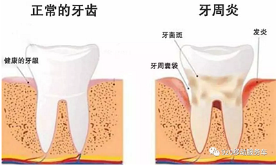 什么是牙龈萎缩？