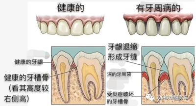 什么是牙龈萎缩？