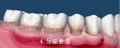 什么是牙龈萎缩？