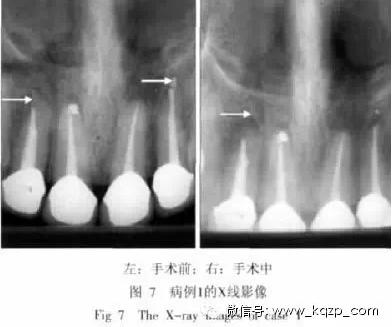X线牙片在牙齿疑难病例诊断中的参考价值