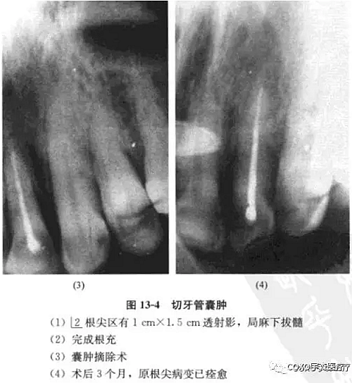 根尖周病的鉴别诊断