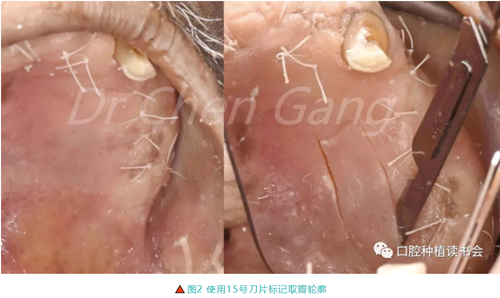高清图解｜游离牙龈（FGG）的获取与移植技术