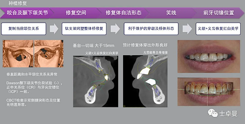 【病例分享】应用全程数字化对牙周炎患者实现全口即刻种植即刻修复