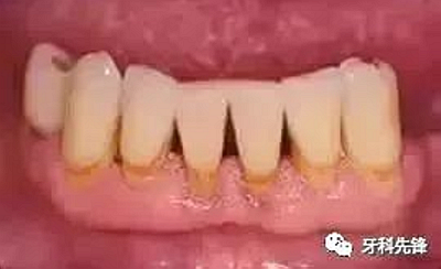 	牙龈萎缩是不治之症？缓解牙龈萎缩5步走！
