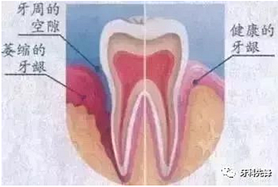 	牙龈萎缩是不治之症？缓解牙龈萎缩5步走！