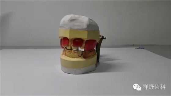图解Frankel-Ⅲ功能矫治器制作步骤