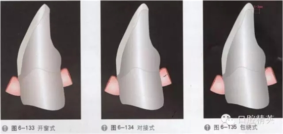 超薄瓷贴面介绍与临床操作步骤