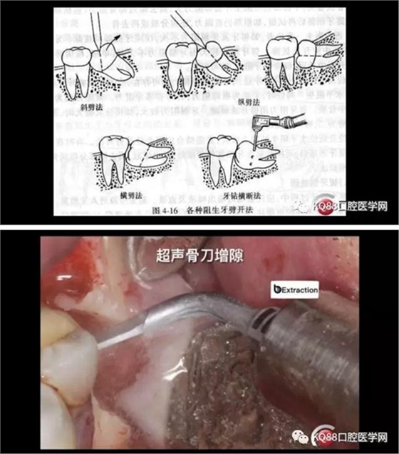 智齿拔除