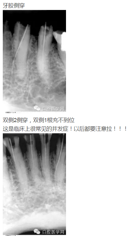几张失败的根管治疗x线诊断
