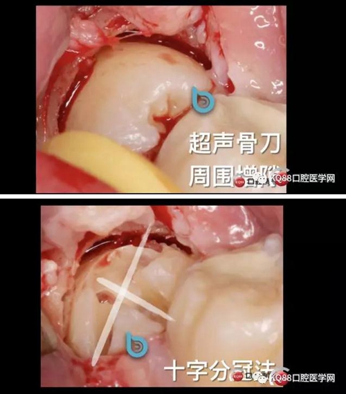 智齿拔除