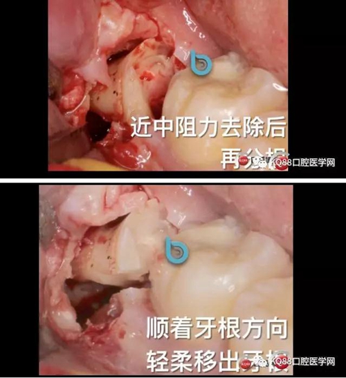 智齿拔除