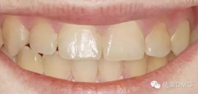 Icon 爱康渗透树脂使用说明书
