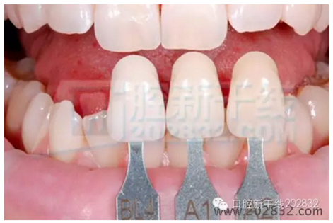 义获嘉 Ivoclar Vivadent 比色板 A-D16色 Ivoclar Shade Guide A-D16